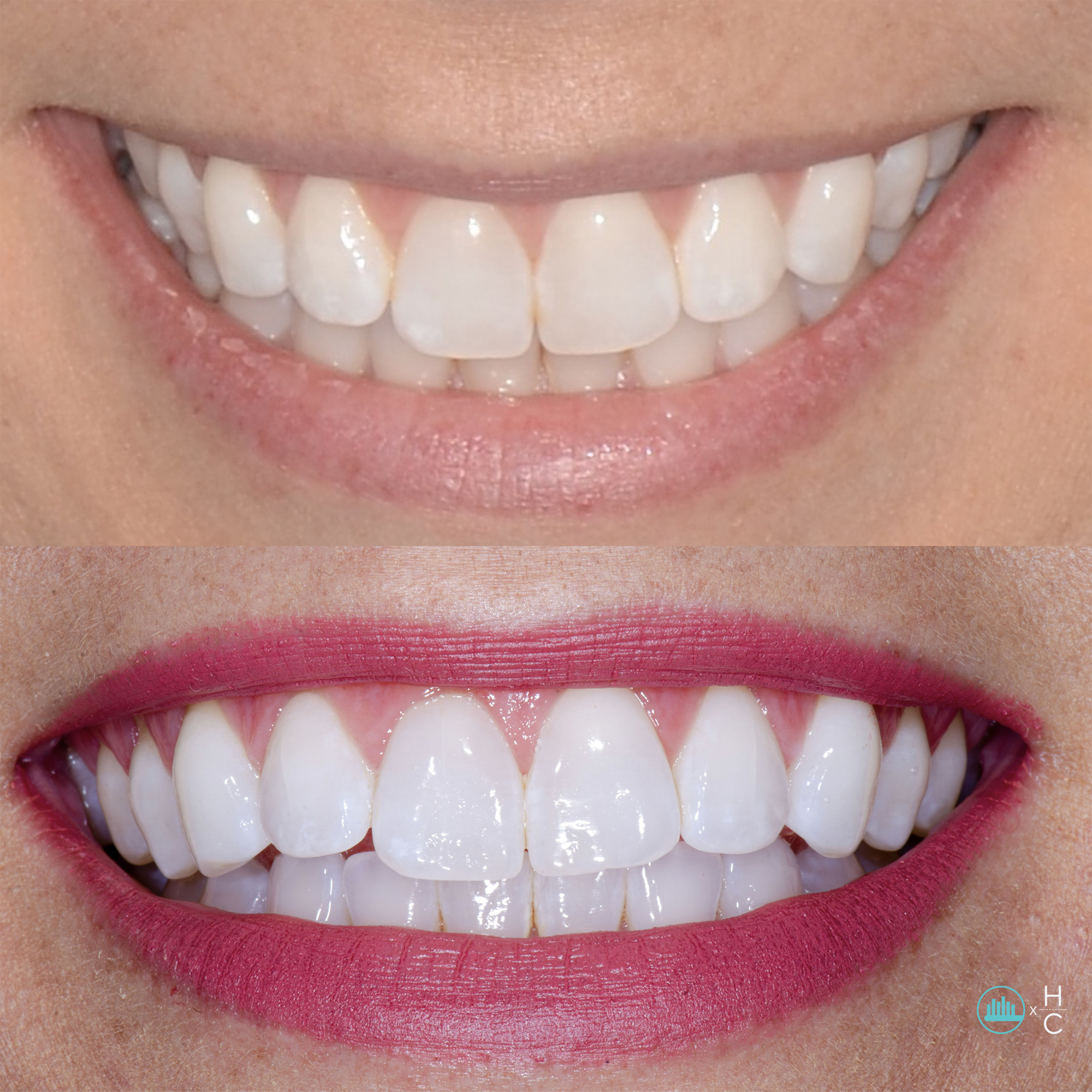 Stay Bright whitening before-and-after comparison with a bright smile