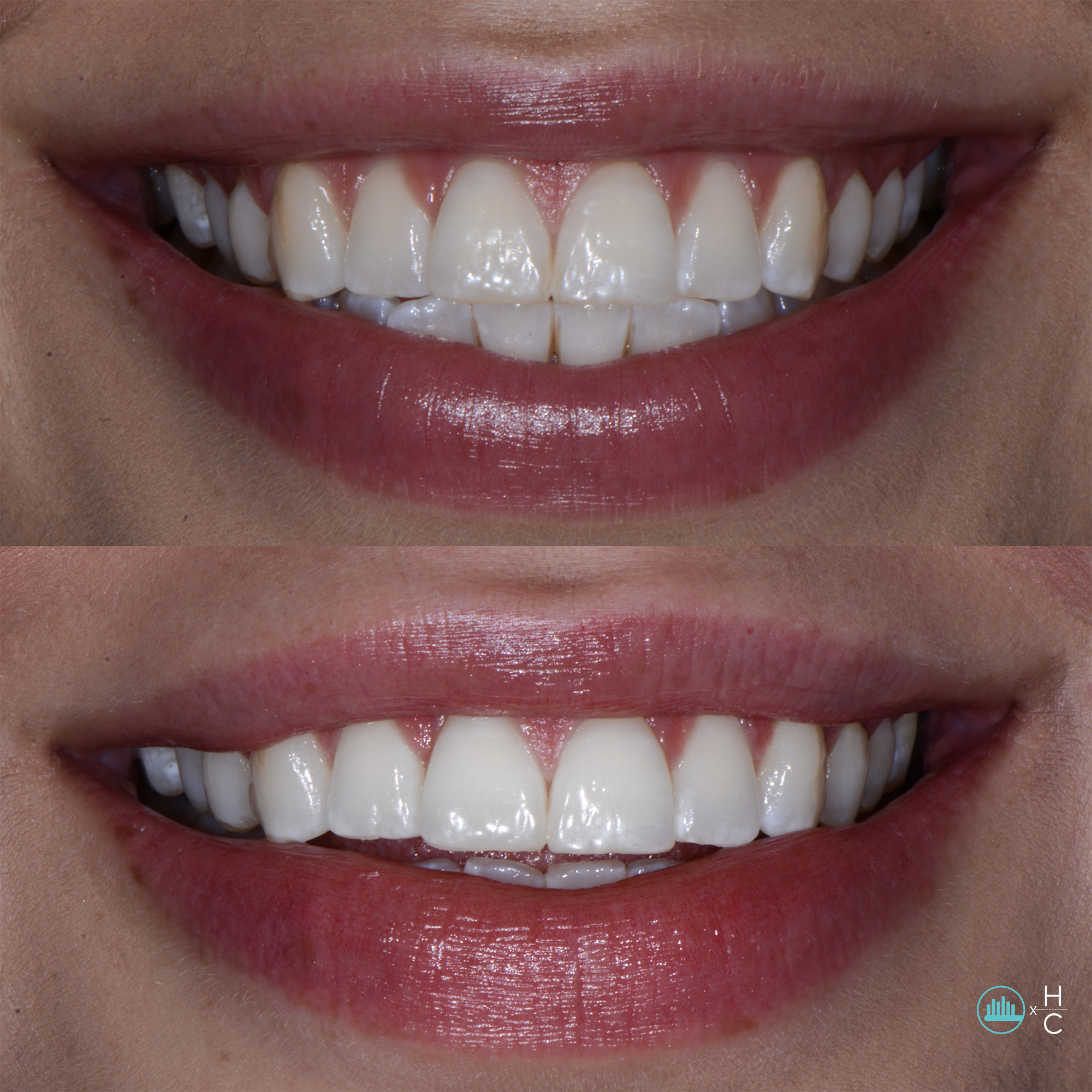 Stay Bright whitening result before-and-after smile comparison