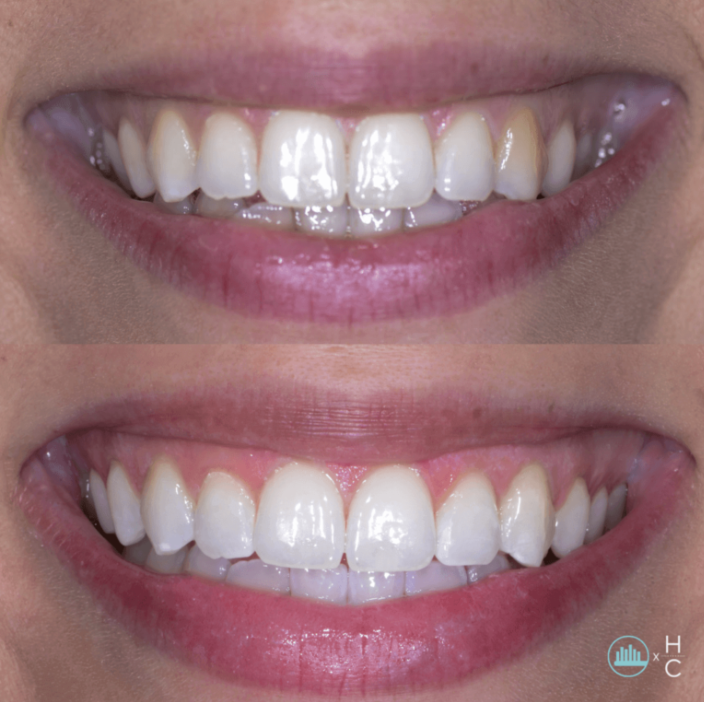 Stay Bright whitening before-and-after smile comparison